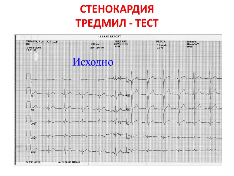 СТЕНОКАРДИЯ ТРЕДМИЛ - ТЕСТ Исходно